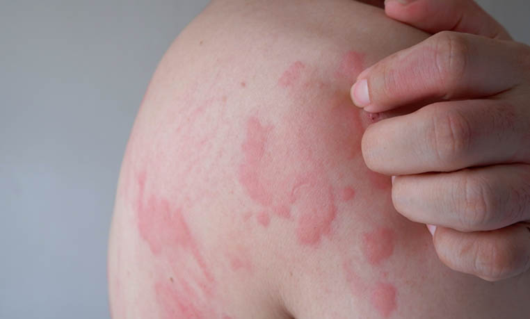 Urticaria aguda y crónica