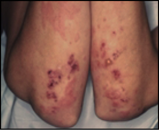 laboratorios dermatitis herpetiforme